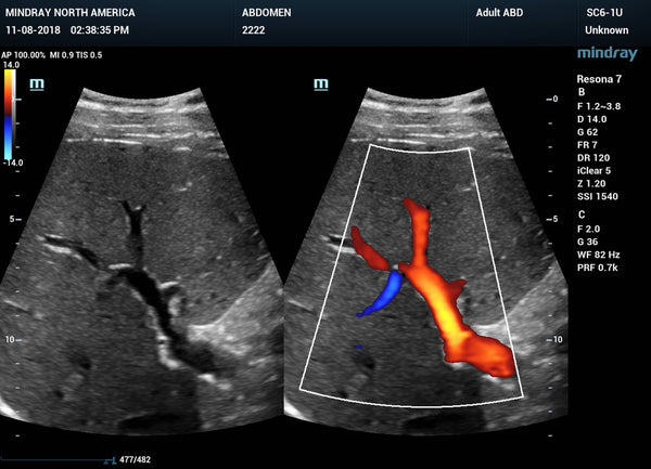 Mindray ZONE Sonography® Technology