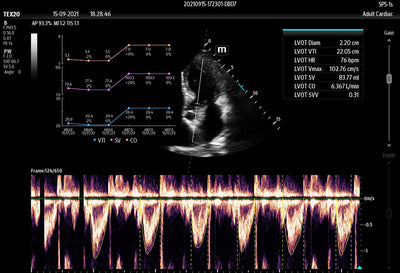 Mindray TE X Portable Ultrasound System