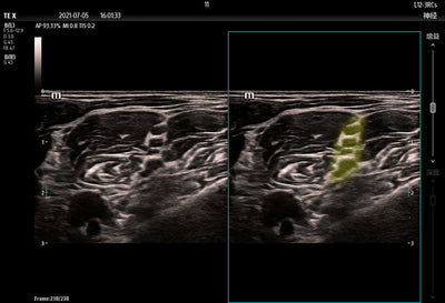 Mindray TE X Portable Ultrasound System