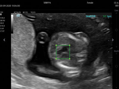 Mindray TE X Portable Ultrasound System