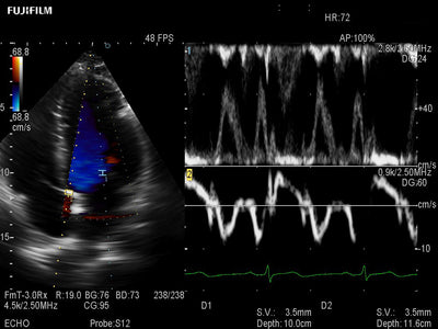 Fujifilm Ultrasound - Cardiovascular Ultrasound Arietta 650DI