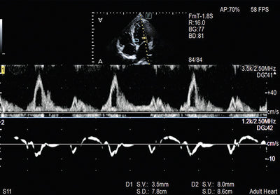 Fujifilm Ultrasound - Cardiovascular Ultrasound Arietta 650DI