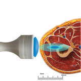 Pulse Wave™: Revolutionizing Shockwave Therapy