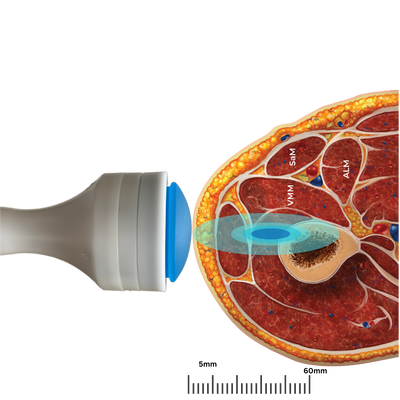 Pulse Wave™: Revolutionizing Shockwave Therapy