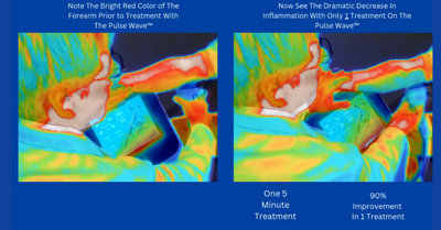 Pulse Wave™: Revolutionizing Shockwave Therapy
