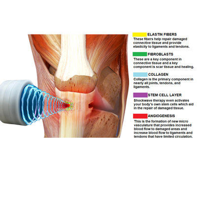 Pulse Wave™: Revolutionizing Shockwave Therapy