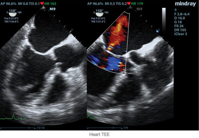 Mindray Ruby Edition M9 Ultrasound System