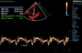 Mindray M9 Premium Ultrasound System