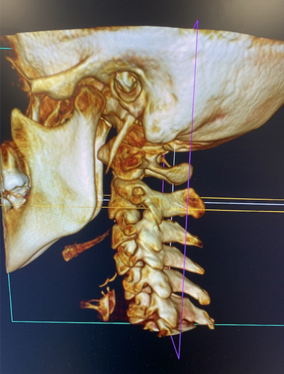 Refurbished Chiropractic CBCT