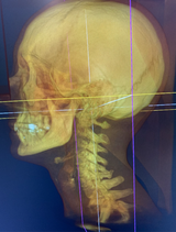 Refurbished Chiropractic CBCT