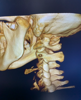 Refurbished Chiropractic CBCT