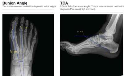 Rayance Podiatry x-ray system with 10x12 Wireless Panel Package